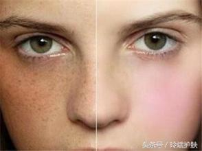 痘痘肌肤泛红怎么办,痘痘肌肤粗糙怎么调理