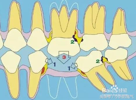 为什么乳牙残根一定要拔掉？一定不能留！