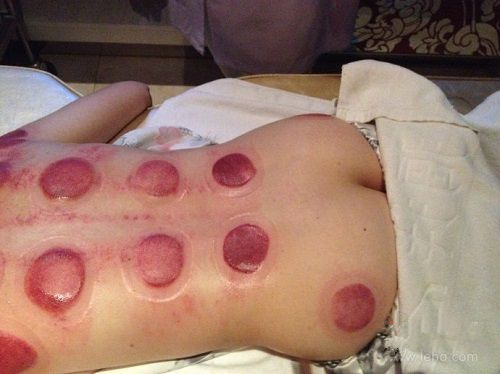 根据拔罐后皮肤的颜色鉴定你的身体到底是怎么了