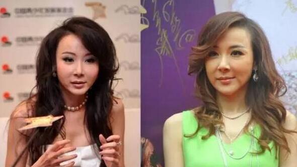 玻尿酸填充法令纹脸僵硬多久,打玻尿酸脸会僵硬吗