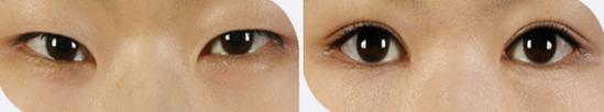 下眼睑下垂术后眼睛会恢复吗,眼睑下至手术前后对比图