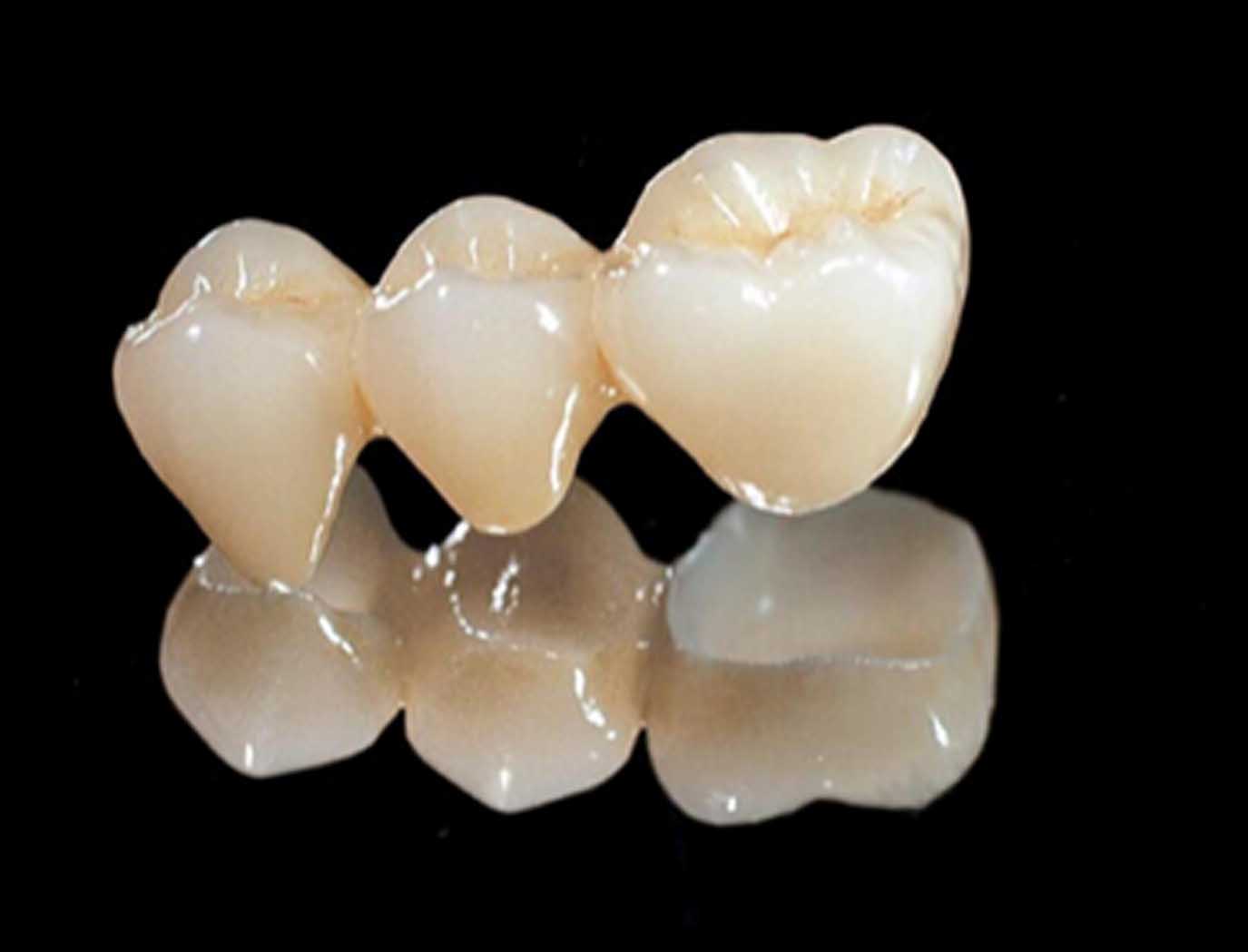 烤瓷牙里面的真牙一般几年会变黑,烤瓷牙与原来牙颜色有差异咋办