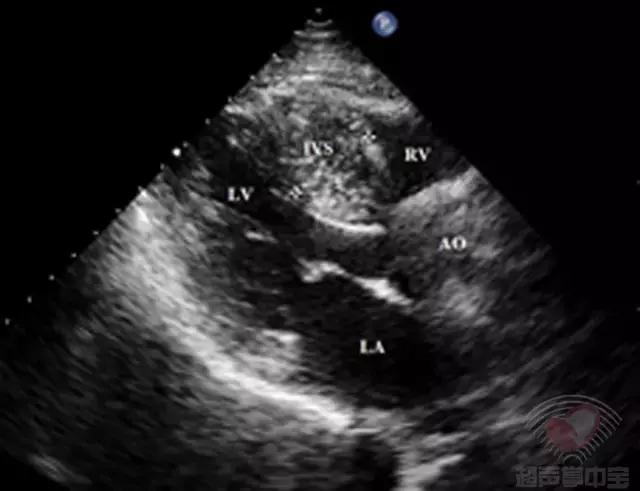 超声肥厚心肌病视频教学,梗阻性肥厚型心肌病消融术