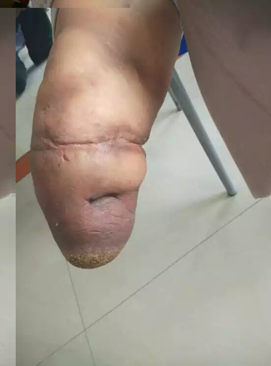 残疾朋友须要注意了：硅胶套，我须要配戴吗？