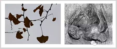 有趣痔疮的知识讲解,怪异的痔疮