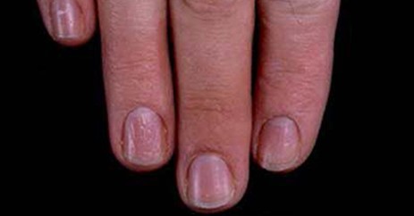 指甲的变化意味着身体的健康状况,指甲上出现这7症状是大病预兆