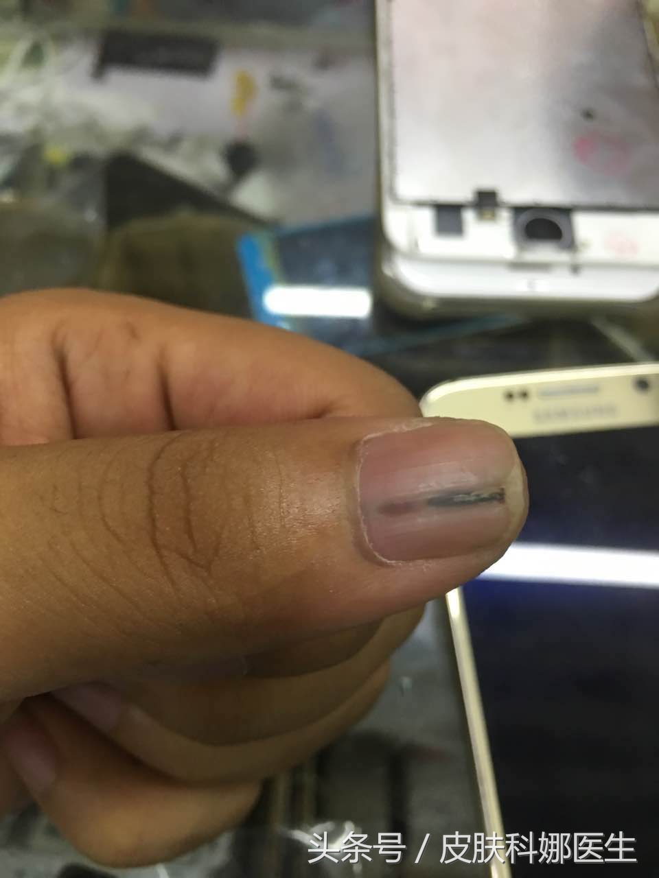 指甲上出现了一条裂缝,指甲上有竖条纹开裂是怎么回事