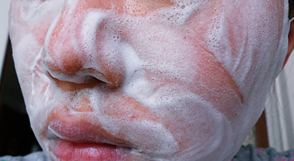 脖子闭口粉刺怎么去除小妙招,粉刺怎么去除简单方法学生