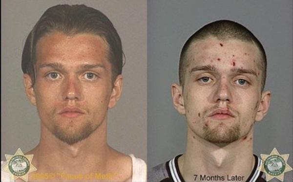 前方高能!吸食*毒冰**后皮肤症状(图文)