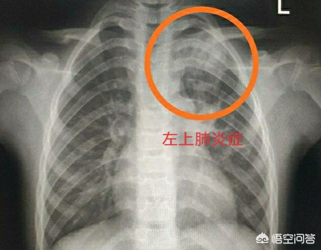 咳嗽肺炎的概率,咳嗽怀疑是新冠肺炎怎么办