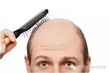 前额头脂溢性脱发最佳治疗方法,头发中间秃了怎么回事脂溢性脱发