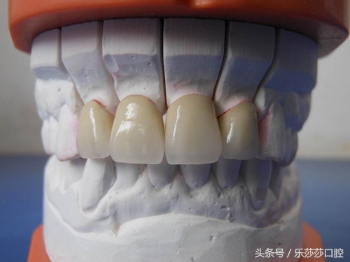 装了烤瓷牙真的是一条不归路吗,烤瓷牙做了后悔一辈子