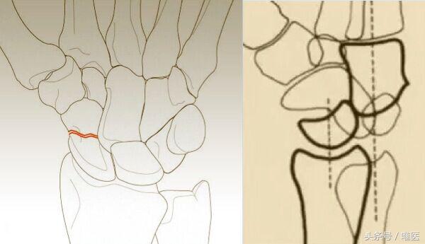 月骨舟骨半脱位手术,手腕舟骨月骨周围脱位要多久康复