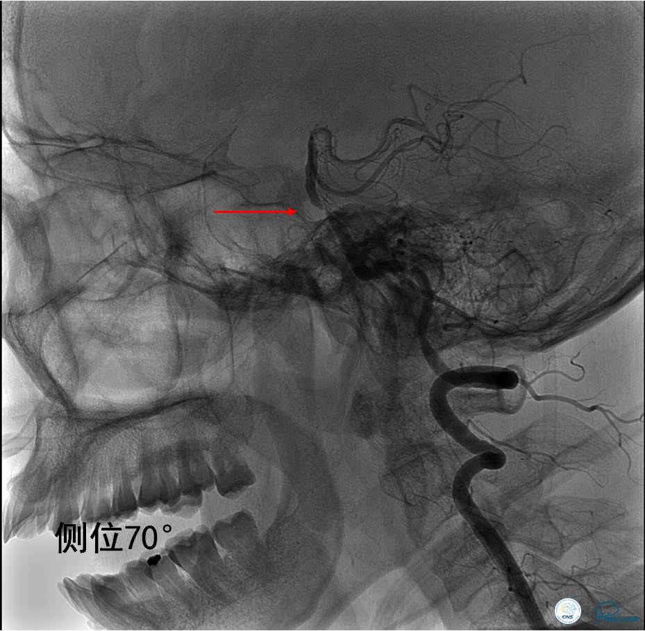 中医治疗基底动脉闭塞,基底动脉尖综合征病例分享