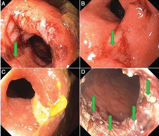 克罗恩病内镜严重程度指数,克罗恩病内镜检查是怎么样的