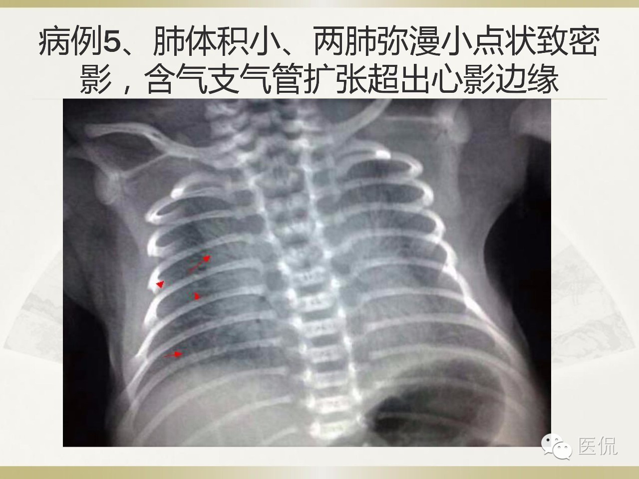 「资料丨医看分享」南边老师肺部群：新生儿透明膜病（HMD）医学影像