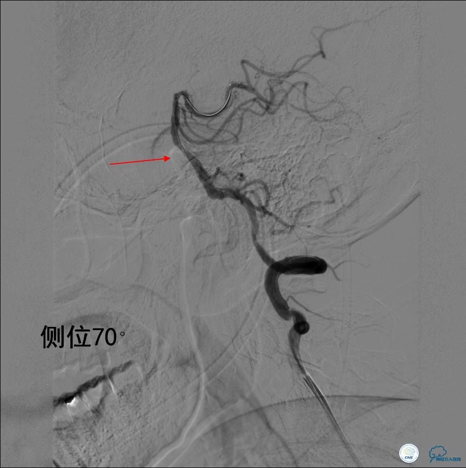 中医治疗基底动脉闭塞,基底动脉尖综合征病例分享