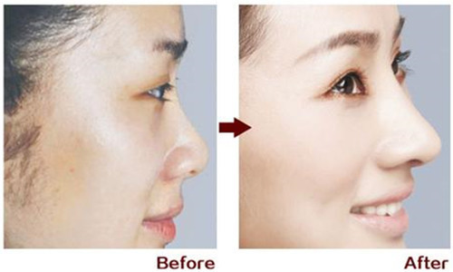 整形隆鼻成功率有多高,假体隆鼻好还是玻尿酸隆鼻好