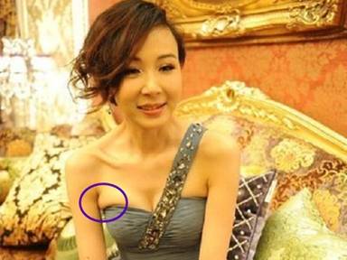 腋窝下有淋巴结会引起乳腺癌吗,腋下淋巴结会是乳腺癌吗