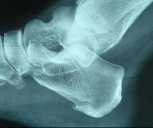 足跟骨刺用陈醋熬成膏状外敷,足跟骨刺泡脚醋加什么中药