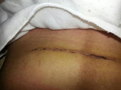 剖腹产要经过几道工序,剖腹产只需切一层