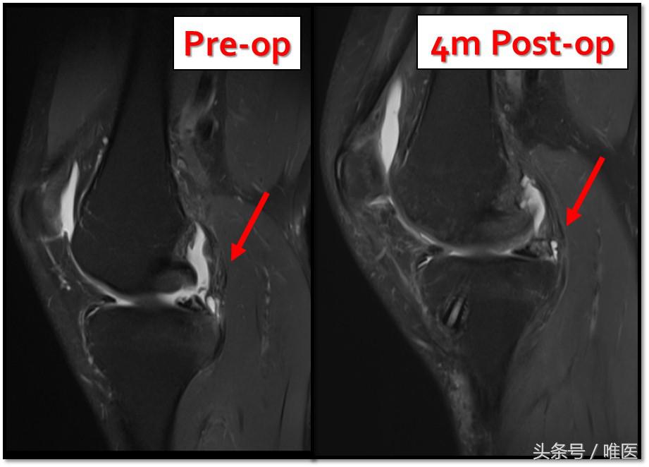 膝关节内侧后角半月板1度损伤,右膝关节内侧半月板后角变性损伤