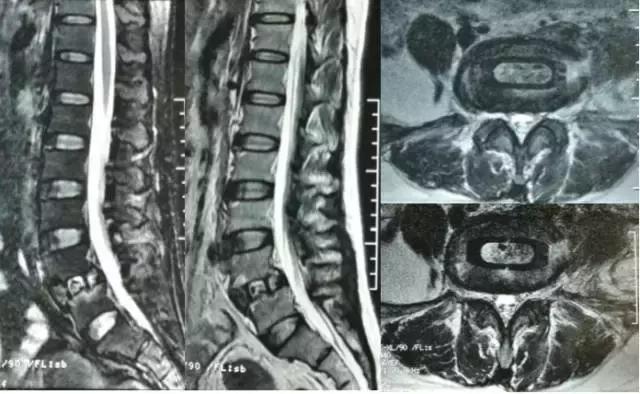 骨伤科可以治疗腰椎滑脱吗,腰椎滑脱微创术后需要康复训练吗