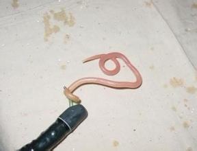 男子腹痛难忍医生实施手术,男子长期腹痛检查出虫子