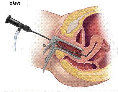 妇科最常见的肿瘤，到底应该怎么办