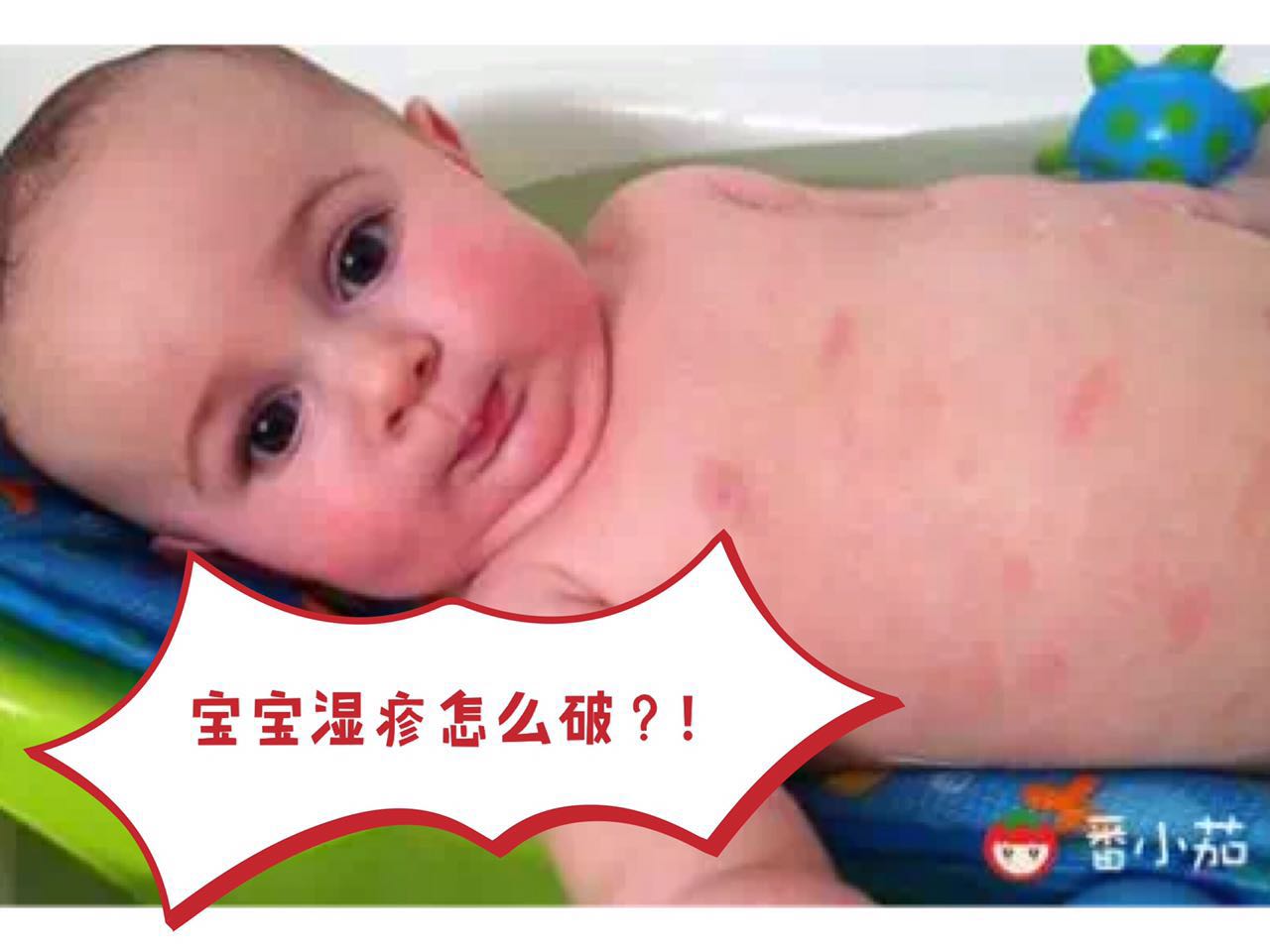 宝宝湿疹可以用激素药么,宝宝湿疹可以拿金银花水擦吗