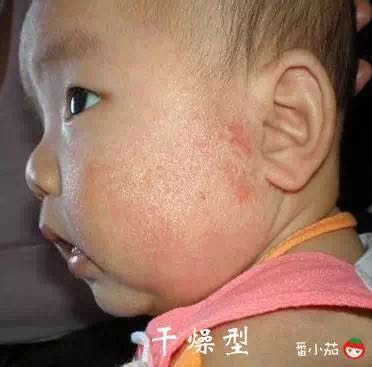 宝宝湿疹可以用激素药么,宝宝湿疹可以拿金银花水擦吗