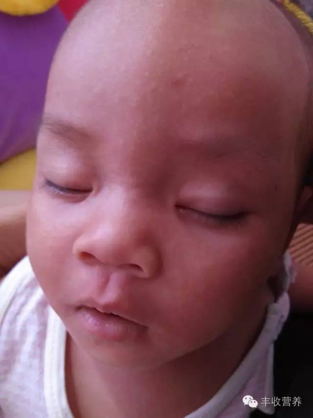 治疗宝宝湿疹家长请收好调理食谱,宝宝湿疹怎么给宝妈解释