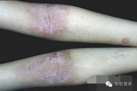 治疗宝宝湿疹家长请收好调理食谱,宝宝湿疹怎么给宝妈解释