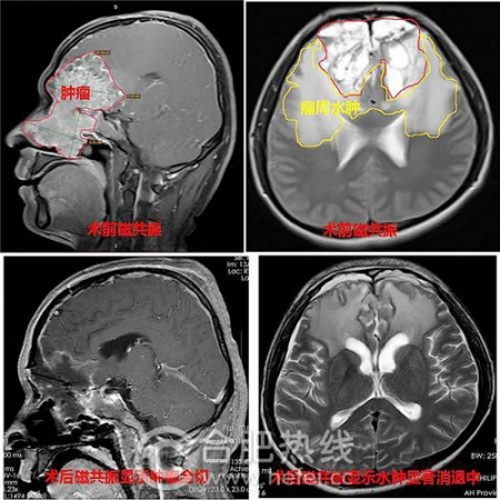年轻小伙头部肿瘤,小伙突发癌症抢救无效死亡
