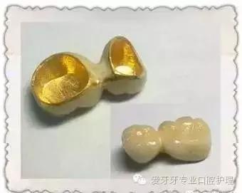 不同价格的牙冠区别在哪里,不同价格的烤瓷有区别吗