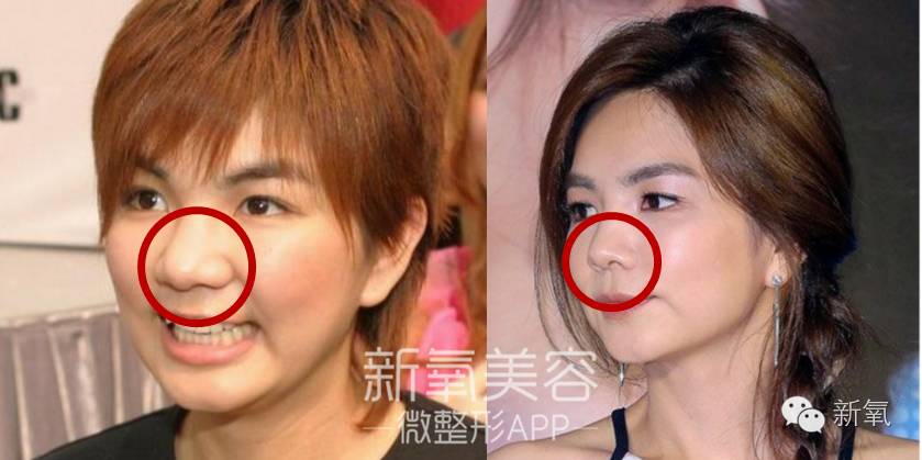 林允是不是整鼻子了,林允隆鼻过吗