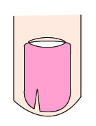 指甲出现白点与竖纹是怎么回事,指甲出现白点什么原因