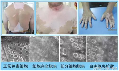 肖海靖点评:白癜风三大伴发疾病你知道多少?