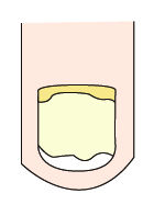 大拇指指甲出现纵纹凸出是什么病,指甲出现黑色的纵纹