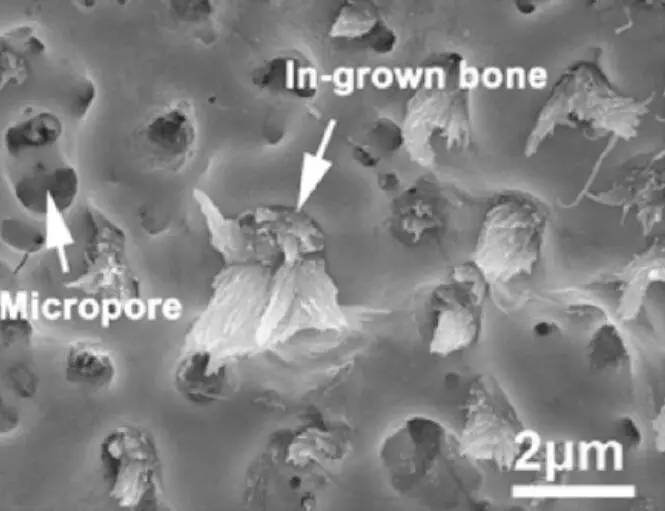 3d打印技术助骨科精准手术,3d打印技术在骨科的应用