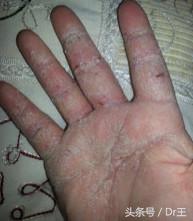 湿疹抹药怎么不见好,湿疹为何擦了药更严重了