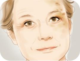 脸上长色斑怎么解决,毛孔粗大色斑多怎么解决