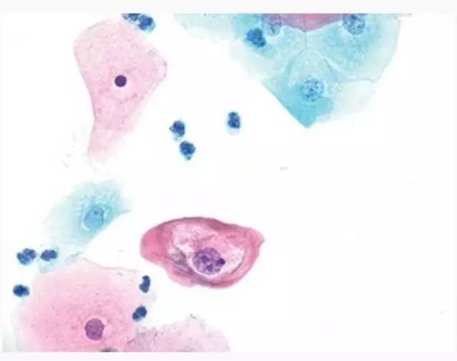 细胞形态符合低度上皮内病变,低度鳞状上皮内病变的临床意义