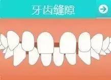 乳牙蛀了需要去拔吗,乳牙蛀了需要治疗吗