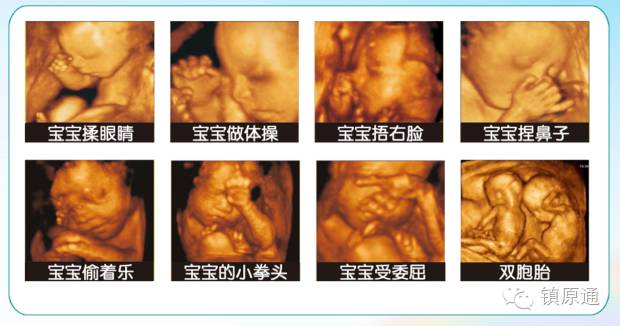 镇原协和医院四维彩超怎么样,镇原做四维多少钱