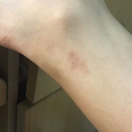 推荐一下最有效的祛疤膏,推荐一款祛疤膏