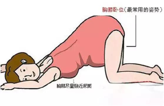 宝宝出生的姿势,孩子出生时的姿势