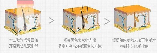 激光脱毛多久后可以正常洗澡,激光脱毛后可以洗澡吗