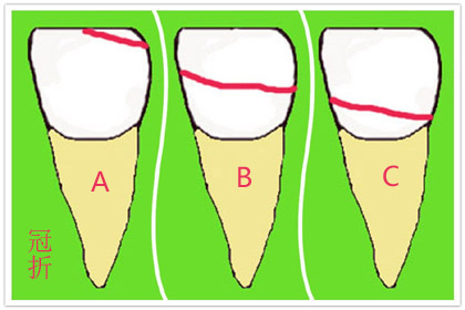 牙齿骨折错位保守治疗能自愈吗,牙齿骨折治疗方法