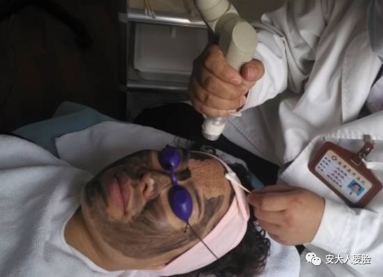 黑脸娃娃收缩毛孔,收缩毛孔黑脸娃娃